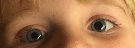 BMJ：单侧间歇性瞳孔散大，什么原因？