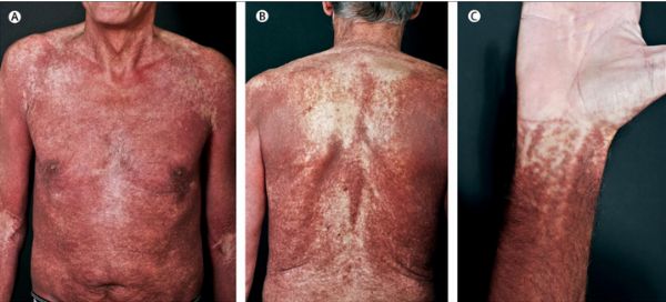 Lancet：全身超过90%的皮肤都存在红棕色<font color="red">皮损</font>，且持续时间超过30年，啥病？——案例报道