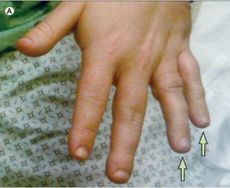 Lancet：第四、五手指短，没有掌指关节，疾病<font color="red">英文</font>名长达30个字母，啥病？——案例报道