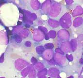 Cancer Cell：癌细胞可以高效代谢果糖——急性髓细胞白血病<font color="red">研究</font><font color="red">的</font>新发现