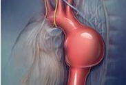 Circulation：对65岁男性进行腹主动脉瘤筛查，性价比十分高！