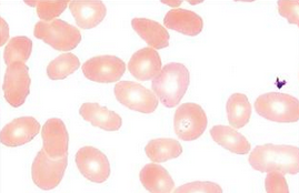 Crit Care Med：输注红细胞，对失血性休克患者的舌下微循环有什么影响？