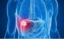 Br J Cancer：疾病进展时间和肝癌总生存期有什么联系？