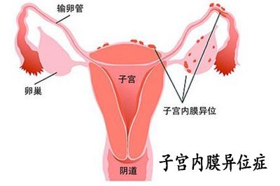 ASRM2016：女性福音！艾伯维妇科药物Elagolix治疗子宫内膜异位症显著减少经期和非经期盆腔疼痛