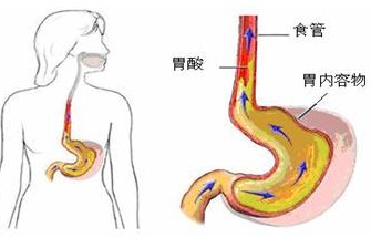 Clin Gastroenterol H：胃食管反流病的又一诊断标志-食管上皮厚度