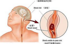 J Stroke Cerebrovasc Dis：血浆免疫蛋白体升高可预测急性缺血性卒中早期出血转化