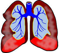 2016ISHLT共识<font color="red">报告</font>：抗体介导的肺排斥反应发布