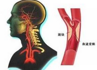 Neurology：隐源性卒中，应<font color="red">警惕</font>非狭窄性颈动脉斑块