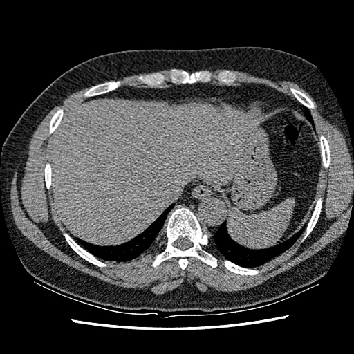 Am J Gastroenterol：CT结肠成像，该由消化科医生还是放射科医生来解读？