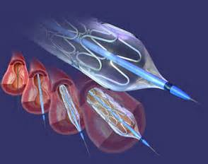 Lancet：治疗冠状动脉狭窄，选择依维莫司生物可吸收支架还是金属支架？