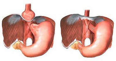 Ann Surg：食管裂孔疝对食管或交界处腺癌术后的预后影响