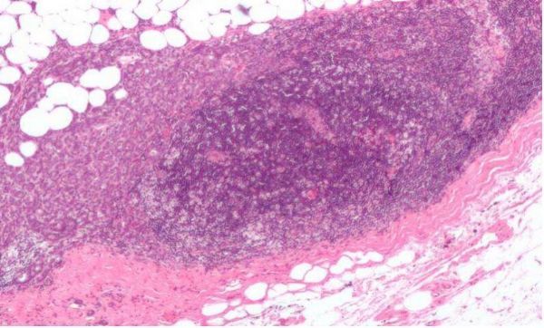 Nat Cell Biol：重磅！科学家发现乳腺癌的新型细胞起源
