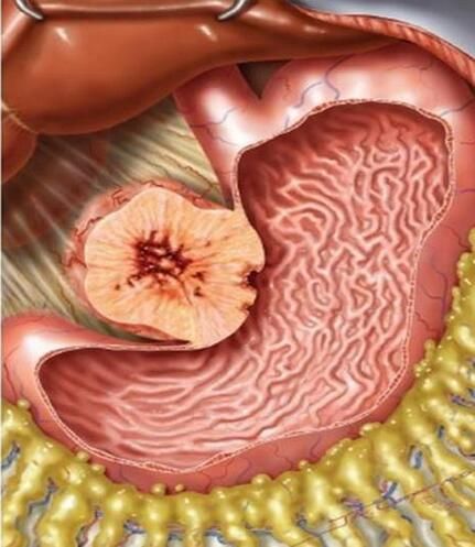 Oncotarget：胃肠间质瘤的新型药物靶点被鉴定