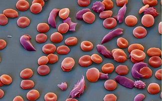 Nature：CRISPR治疗镰刀形<font color="red">细胞</font>贫血症临床前试验成功