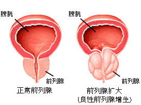 JAMA Surg：2012年后，前列腺活检和<font color="red">切除术</font>在下降