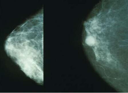 JAMA Oncol：高水平维生素D或可明显改善乳腺癌患者的生活质量