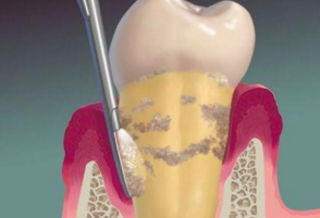 Am J Med：牙周袋深度和血糖也能影响慢性肾脏病的进展？
