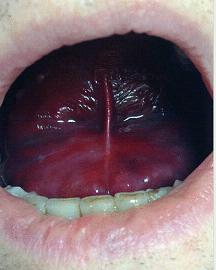 BMJ：溶栓治疗并发自发性舌血肿——<font color="red">案例</font>报道