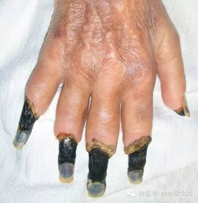手指皮肤坏死图片