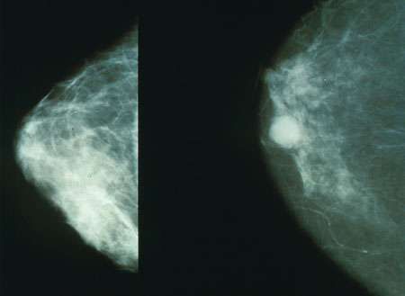 Cancer Res：三阴性乳腺癌转移必需蛋白BRD4被发现