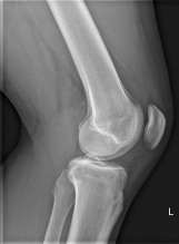 BMJ：你发现这张普通膝关节平片中暗藏的典型标志了吗？-案例报道