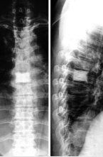 BMJ：老年人因“象牙脊椎”引起的胸背部疼痛-案例报道