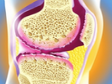 胫骨高位截骨术治疗膝关节骨关节炎的现状
