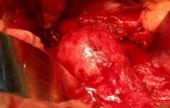 <font color="red">新英格兰</font>杂志：关于腹主动脉瘤修补术的指征