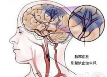 颅内动脉夹层的影像学诊断中国专家共识