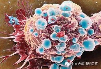 JCO：西妥昔单抗联合放化疗治疗伴有HIV感染的肛门癌患者的效果有待商榷