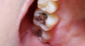 国际组织支持全球禁用牙科汞合金行动
