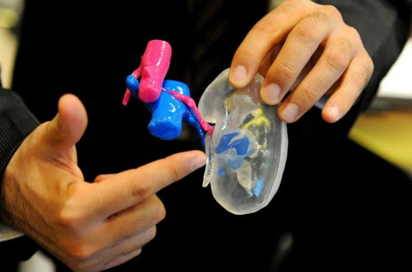 透明3D打印手术模型帮助拯救肿瘤患者肾脏