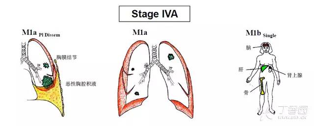 <font color="red">第八版</font>肺癌分期 2017 年 1 月 1 日起实施！4 张图表教你记住