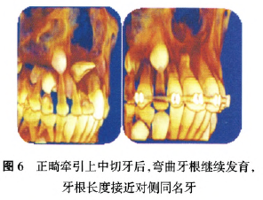 弯根牙的临床综合治疗及正畸早期矫治的可能性