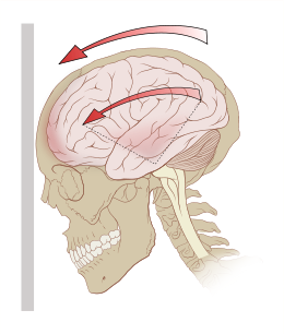 《<font color="red">科学报</font>道》一种简易的脑震荡诊断技术