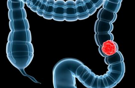 射频消融在结直肠癌肝转移中的临床应用进展