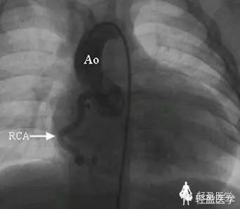 【罕见病例】患者的左冠状动脉去哪了？