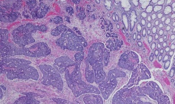 Oncotarget：科学家鉴别出能有效抵御结直肠癌发展的关键酶类