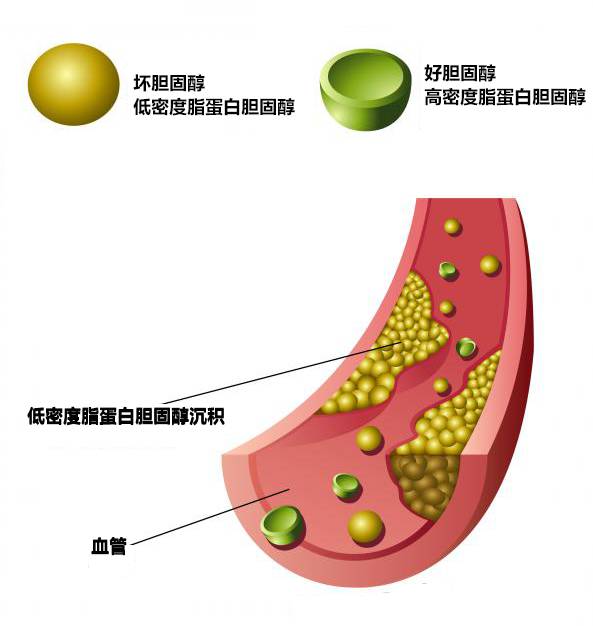 手把手教你看懂检查<font color="red">报告</font>——<font color="red">血脂</font>常规