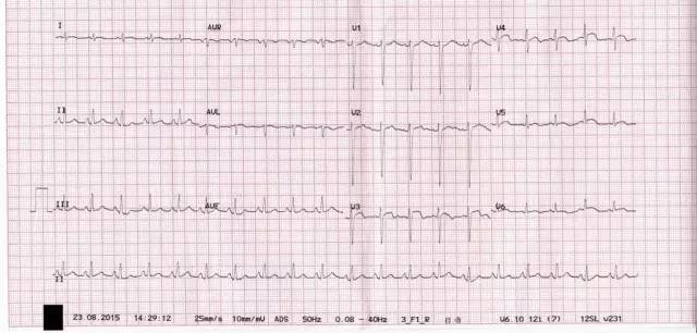 心电图ST段抬高，可能是哪些疾病？