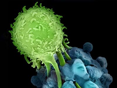 免疫细胞治疗——淋巴瘤病人的新希望