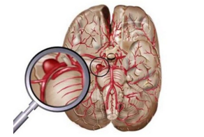 Neurology：<font color="red">血液</font>tau蛋白浓度或可预测脑震荡恢复时间