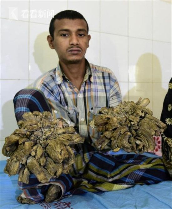 一年16次手术切掉10斤枝状疣 孟加拉国“树人”基本治愈有望创造医学奇迹