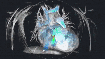 GE联手Arterys：首次将心脏MRI带入4<font color="red">D</font>智能云端时代