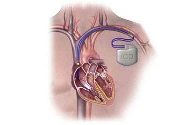 JACC：植入式心脏复律除颤器在老年患者中的效果怎么样呢？