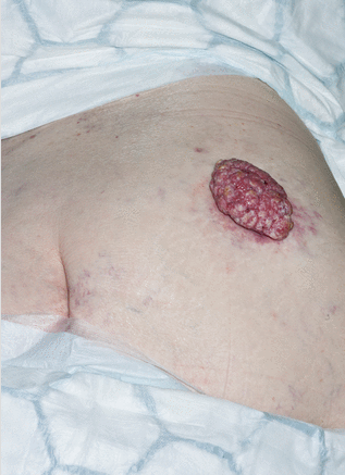 BMJ：在臀部长出的巨大菜花状肿块是啥肿瘤？-案例报道