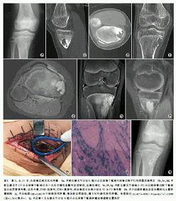 尤文氏肉瘤误诊为非骨化性纤维瘤1例
