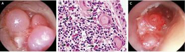 NEJM：嗜酸细胞性<font color="red">中耳炎</font>-案例报道
