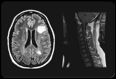 Neurology：多发脑梗死和<font color="red">ICAS</font>对轻微脑卒中或TIA患者有何影响？