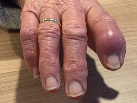 BMJ：患者手指红肿是怎么回事？-案例报道